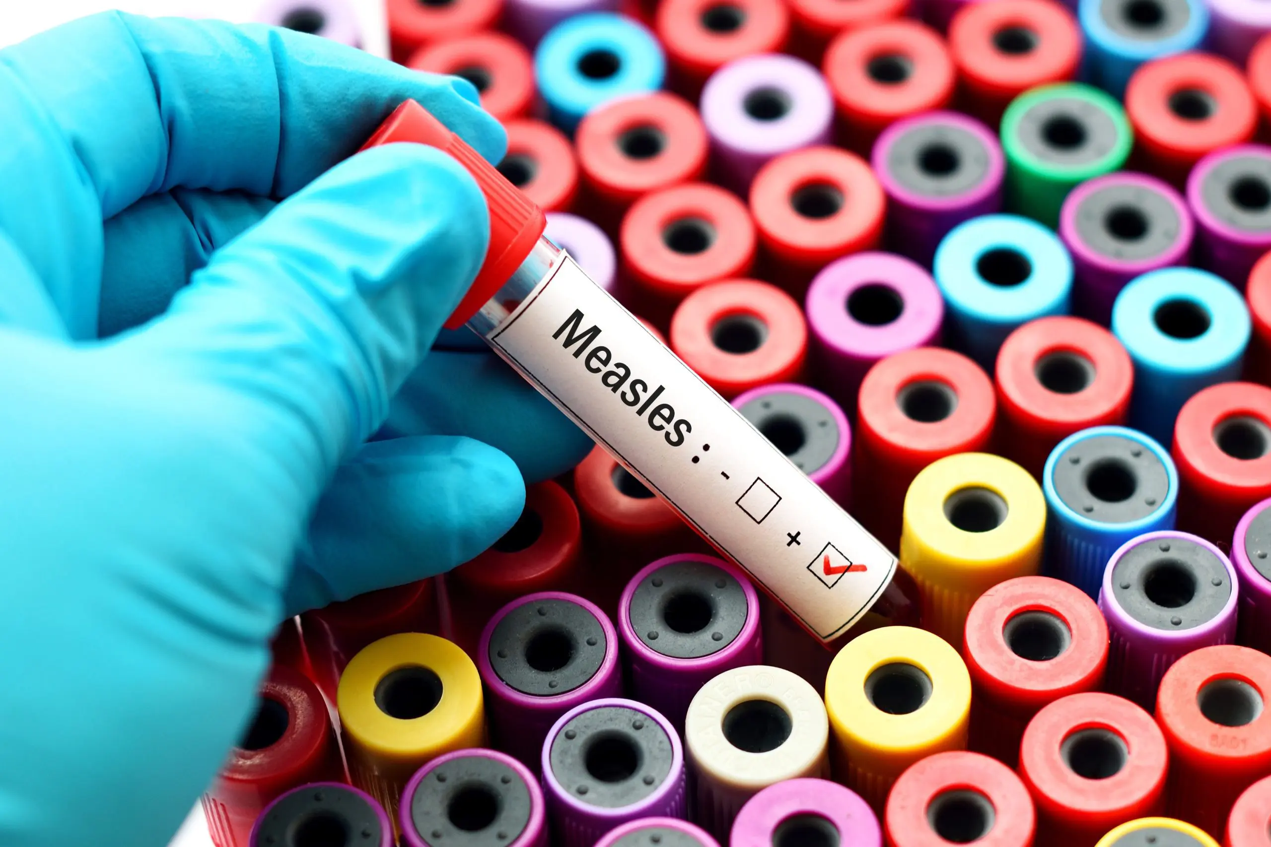 Measles