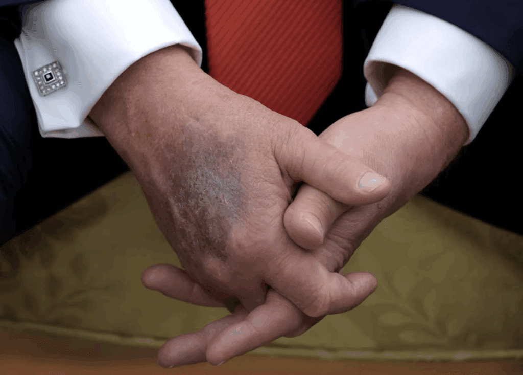 Donald Trump's Hand Bruises
