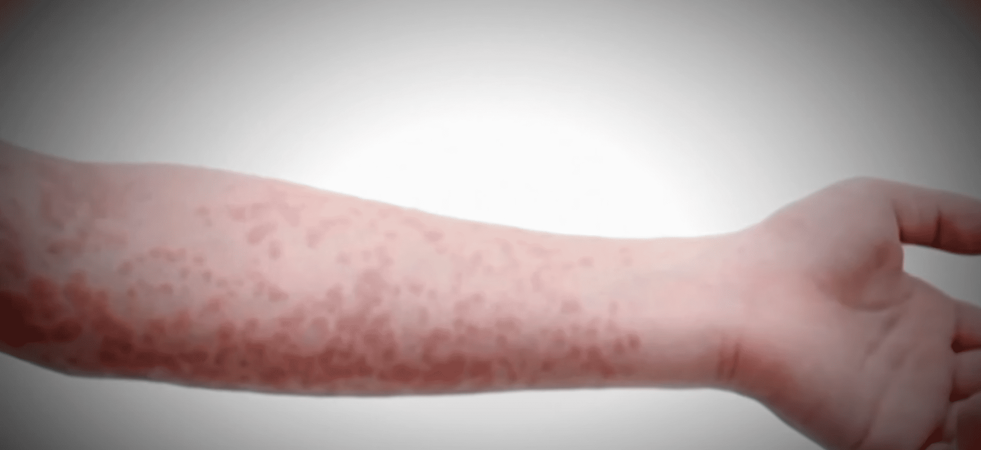 US Measles Cases