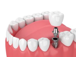 Evansville dentist